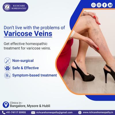 Varicose Veins Homeopathy Treatments in Bangalore  - Bangalore Other