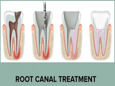 Root Canal Treatment in Gurgaon And Dental Aesthetics  - Gurgaon Other