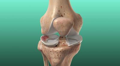 Meniscus Injuries Treatment in Pune - Other Health, Personal Trainer
