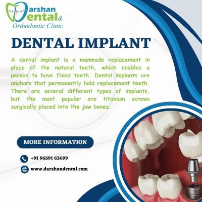 Dental implant clinic | Best Dental Clinic In Kanyakumari - Chennai Other