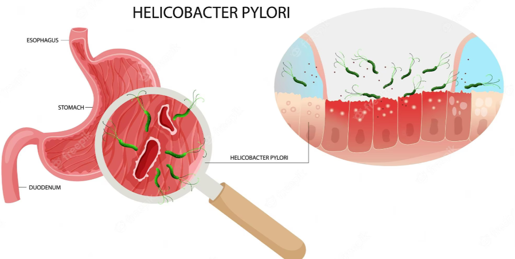 Get the Best H. Pylori Infection Treatment - Los Angeles Health, Personal Trainer