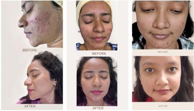 Effective Acne Scar Treatment at The Skin Firm Clinic, NIBM - Pune Health, Personal Trainer