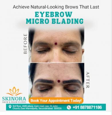 Skin brightening treatment in hyderabad - Hyderabad Other