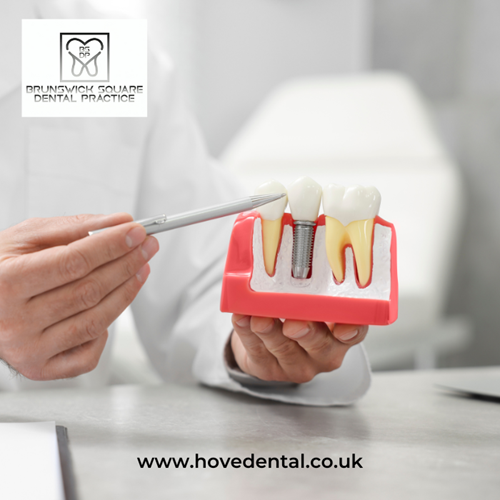 Bruxism Solutions Dental Implants in Brighton