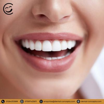 Dental Porcelain Veneers - Sydney Other