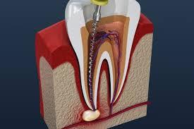 Root canal in Abudhabi