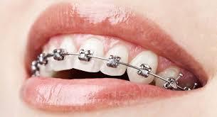 Dental braces in Abudhabi