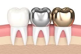 Dental crowns in Abu dhabi