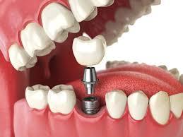 Best dental implants in Abudhabi