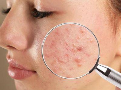 Acne Treatment in Lucknow - Lucknow Health, Personal Trainer