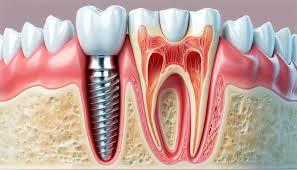 Dental implants in Al Ain