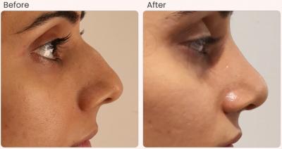 Nose Reshaping Surgery in Delhi - Lucknow Other