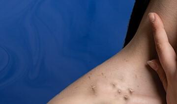 Skin Tag Removal Clinic in Santacruz West | Safe & Effective Treatment at Kosmoderma
