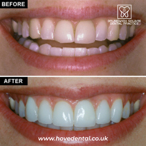 Cosmetic dentistry veneers in Brighton