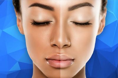 Best Melasma & Laser Treatment for Pigmentation in Santacruz West | Kosmoderma