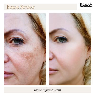 Look Younger at Botox Newport Beach 