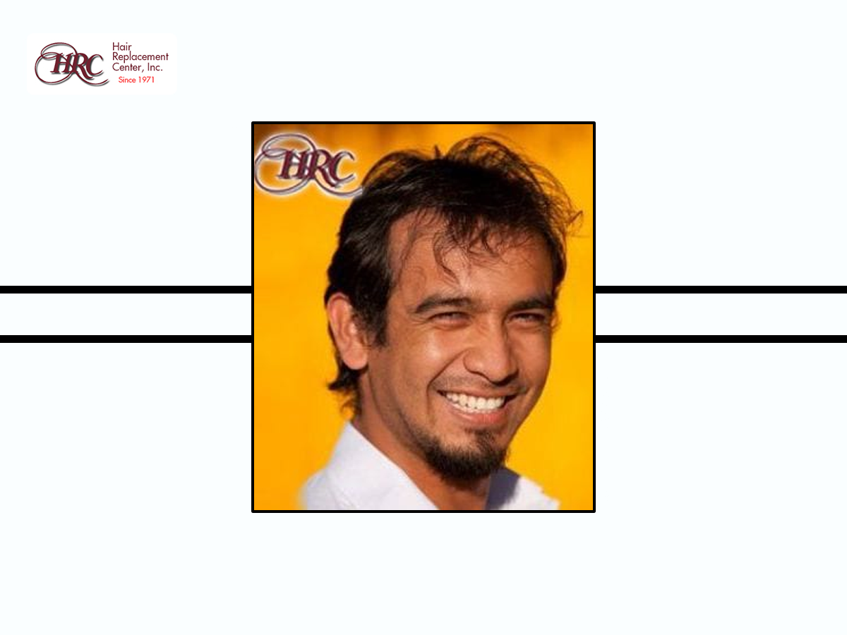 Best Hair Systems for Men Offering Style and Durability