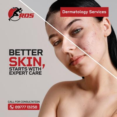 Ecpert skincare for Vitiligo Treatment in Hyderabad  