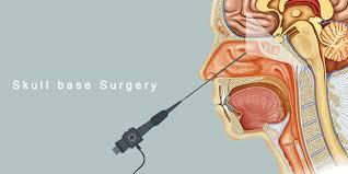 Skull Base Surgery: Advanced Tools for Delicate Procedures