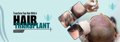 Hair Transplant Clinic in Delhi