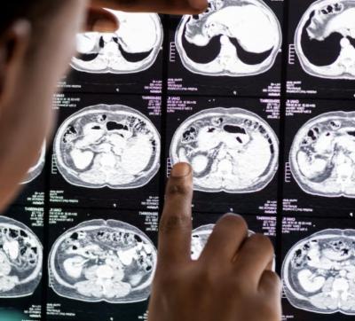 Neuro Navigation – Advanced Surgical Guidance for Brain Procedures