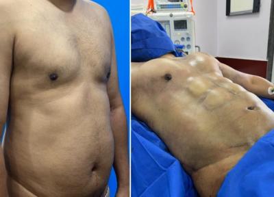 Six-Pack & Chest Pack Surgery in India – Trusted Hands, Perfect Results