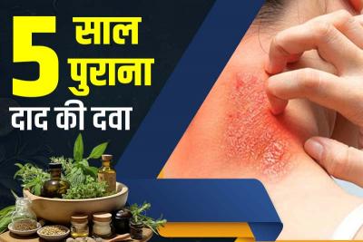5 साल पुराना दाद की दवा — असरदार और घरेल
