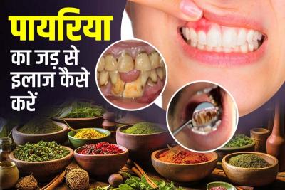 पायरिया को जड़ से खत्म करने का रामबाण 