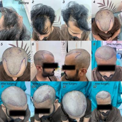 वरना एक दिन होगा दुनिया पर केवल गंजेपन - Indore Health, Personal Trainer