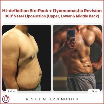 6 Pack Abs Surgery in Delhi | Get Sculpted Abs at Divine Cosmetic Surgery