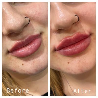 Wrinkle Reduction Melbourne – Smooth, Youthful Skin - Melbourne Other