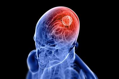 Trigeminal Neuralgia Treatment in Noida