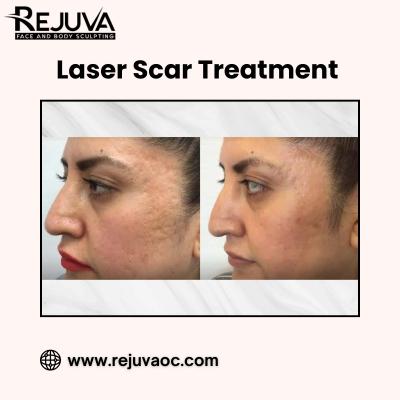 Expert Laser Scar Treatment in Newport Beach