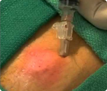 Safe and Effective Abscess Treatment in Lenoir City