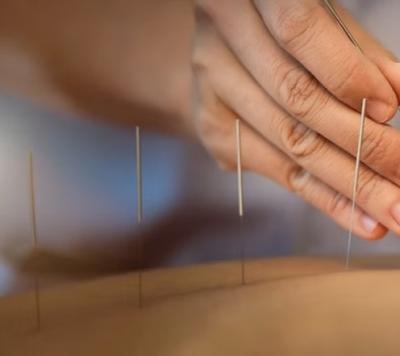 Best TCM Acupuncture Clinic in Novena - Singapore Region Other