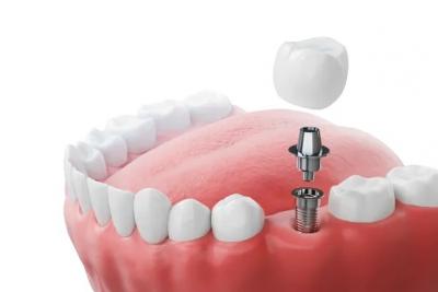 Tooth Implant Albany - New York Other