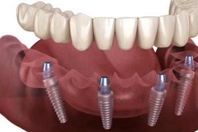 Tooth Implant Albany - New York Other