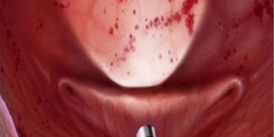 Venereal & Sexual Diseases Treatment in Bhubaneswar - Gurgaon Other