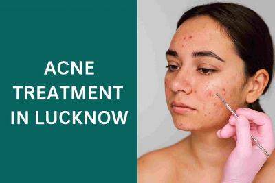 Acne & Pimple Treatment in Lucknow