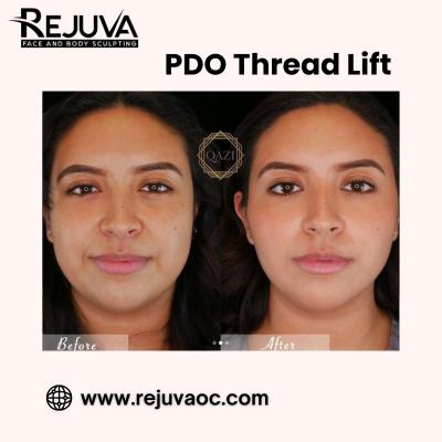 PDO Thread Lift Newport Beach