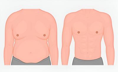 Gynecomastia in Abu Dhabi- Dr. Parag Telang