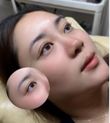 Best service for Laser Hair Removal in Tampines