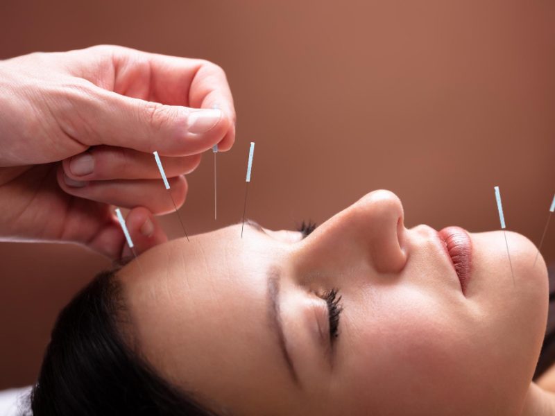 Best Acupuncture Clinic in Hollywood, FL – Drug-Free Pain Solution