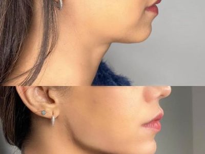 Facelift Surgery Cost in Mumbai - Hair & Shape Clinic