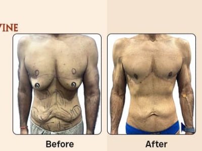 Post-Pregnancy & Post-Weight-Loss Loose Skin Treatment | Divine Cosmetic Surgery in Delhi