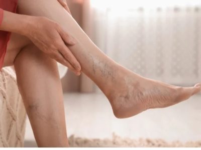 Advanced Care for DVT with Faster Recovery Options