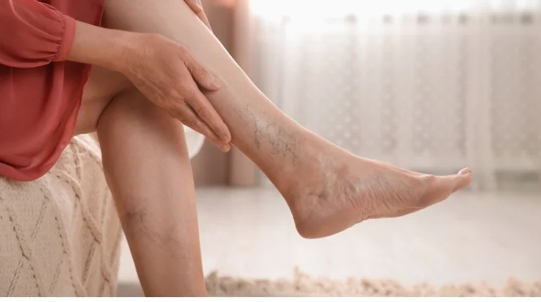 Advanced Care for DVT with Faster Recovery Options