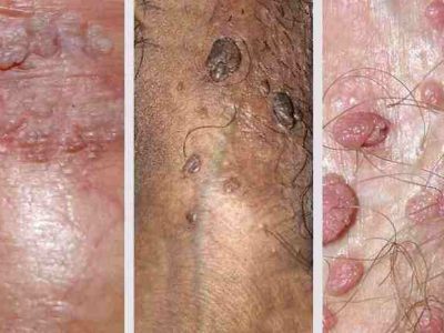 Remove Genital Warts Naturally & Regain Confidence