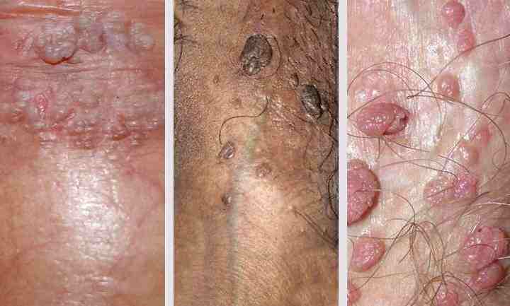 Remove Genital Warts Naturally & Regain Confidence