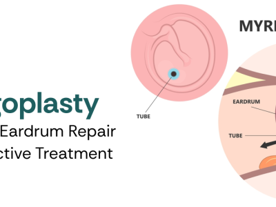 Myringoplasty Surgery for Eardrum Repair – Safe & Effective Treatment